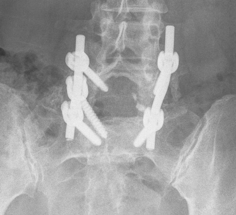 Spondylolithesis Transfixing Screw Lateral